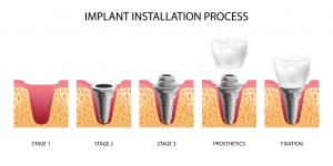 Best dental implant clinic in chennai